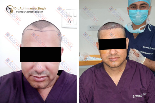 dr abhimanyu singh hair transplant jaipur patient