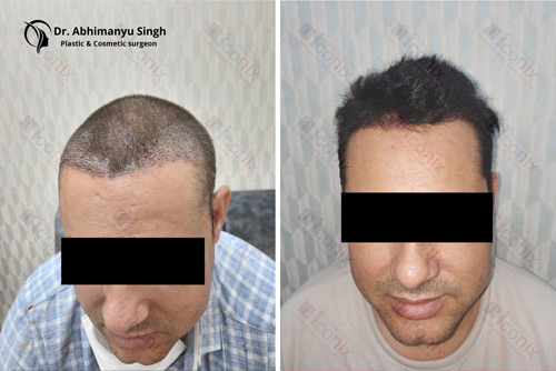 hair transplant clinic jaipur