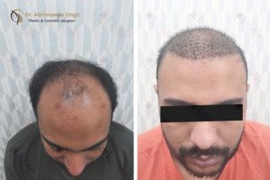 Hair Transplant (Before - After)
